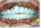 歯肉のメラニン色素